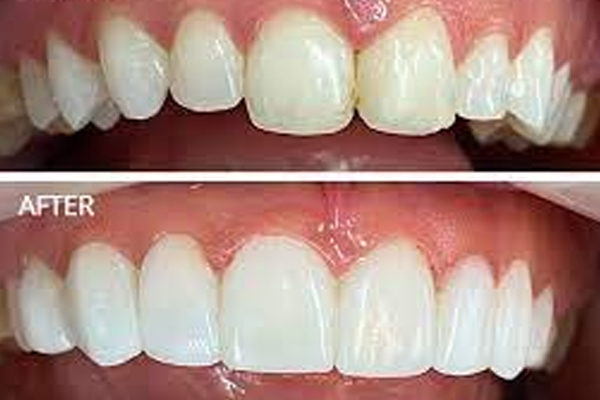 https://thedentists.in.net/wp-content/uploads/2024/12/Composite-Bonds.jpg