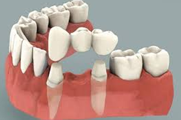 https://thedentists.in.net/wp-content/uploads/2024/12/Crown-Bridges.jpg