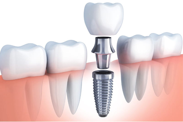 https://thedentists.in.net/wp-content/uploads/2024/12/Dental-Implants.jpg