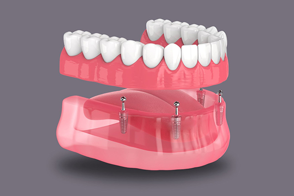 https://thedentists.in.net/wp-content/uploads/2024/12/Dentures.jpg