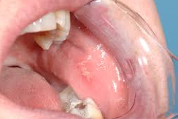 https://thedentists.in.net/wp-content/uploads/2024/12/Oral-Lesions-Treatment.jpg