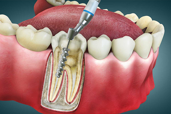 https://thedentists.in.net/wp-content/uploads/2024/12/Root-Canal-Treatment.jpg