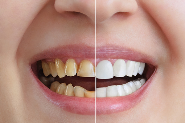 https://thedentists.in.net/wp-content/uploads/2024/12/Teeth-Whitening.jpg