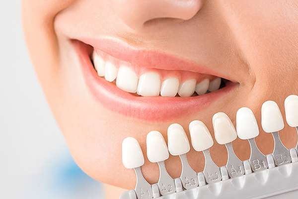 https://thedentists.in.net/wp-content/uploads/2024/12/Veneer-Laminate.jpg