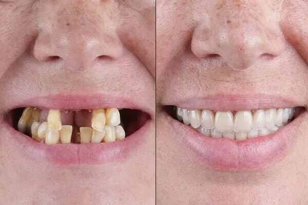 https://thedentists.in.net/wp-content/uploads/2024/12/full-mouth-rehabilitation.jpg